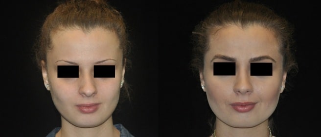 Before and after image of a woman with thin brows before and thicker brows after an eyebrow transplant in Houston, TX.
