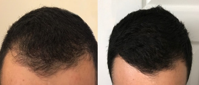 Before and after hair transplant by the experts at ILEA Hair restoration in Houston, Texas