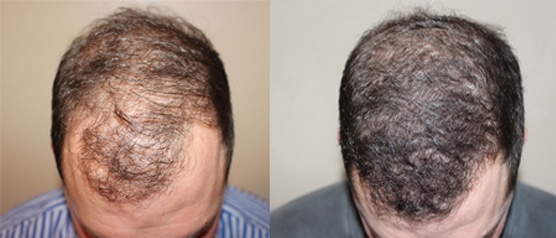 Before and after photo of a man with severe hair loss on his scalp before and thicker, fuller hair after a hair transplant by the experts at ILEA Hair Restoration in Houston, Texas.
