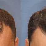 Before and after photo showing a man with a severely receded hairline and hair loss before and a thicker, full head of hair after a hair transplant by the experts at ILEA Hair restoration in Houston, Texas.