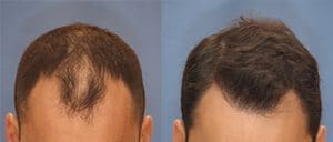 Before and after photo showing a man with a severely receded hairline and hair loss before and a thicker, full head of hair after a hair transplant by the experts at ILEA Hair restoration in Houston, Texas.