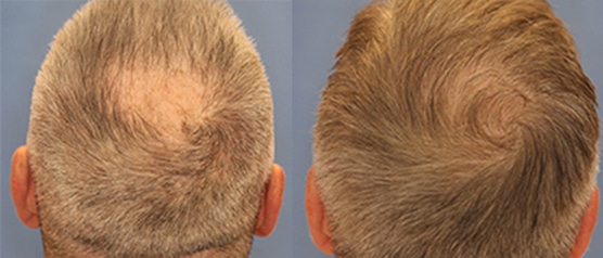 Before and after photo showing a man with hair loss on the back of his head before and fuller, thicker hair after hair transplantation at ILEA Hair Restoration.
