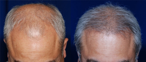 Before and after photo showing an older man with extreme hair loss on his scalp before and more hair growth after hair transplantation in Houston, TX.