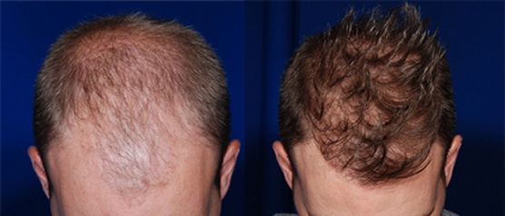 Before and after photo showing a man with hair loss on his scalp before and fuller, thicker hair after hair transplantation at ILEA Hair Restoration.