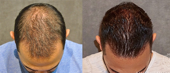 Before and after photo showing a man with moderate hair loss before and a fuller, thicker head of hair after a hair transplant at ILEA Hair Restoration.