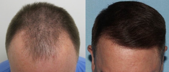 Before and after photo of a man's scalp with thinning, balding hair on his scalp before and a fuller, thicker head of hair after hair restoration treatment in Houston, Texas.