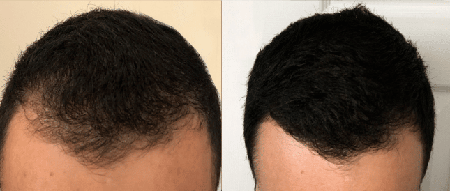 Before and after photo showing a man's thinning, receding hairline before and fuller, more defined hairline after hair restoration treatment in Houston, Texas.