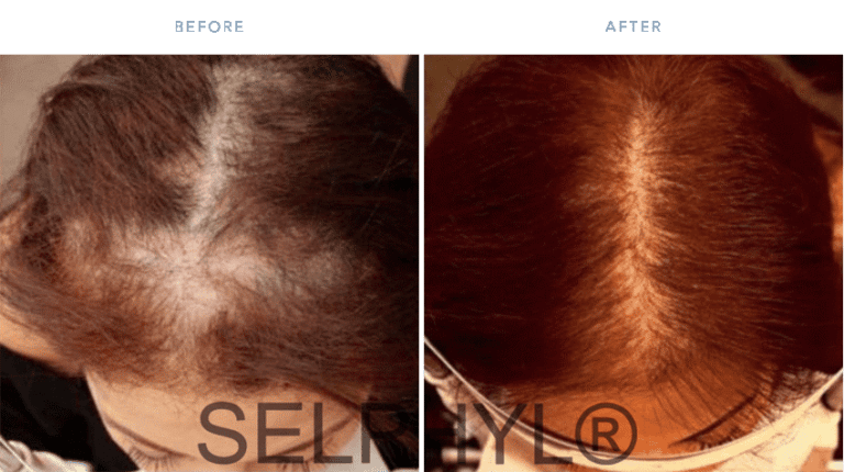 Before and after photo showing a woman's scalp with balding, thinning hair before and fuller, thicker hair after Sephyl System hair injection treatment at ILEA Hair Restoration in Houston, Texas.