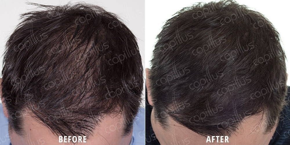 Before and after image of a man's scalp showing hair loss before and thicker, fuller hair after capillus cap treatment at ILEA Hair Restoration in Houston, Texas.