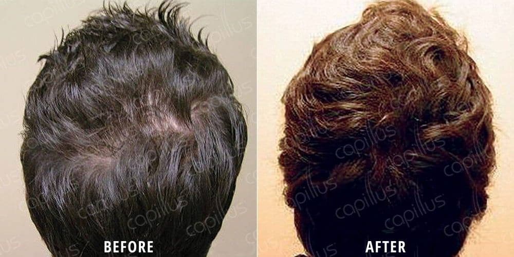 Before and after photo of a man with hair loss on the crown of his head before and fuller, thicker hair after Capillus Cap treatment at ILEA Hair Restoration.