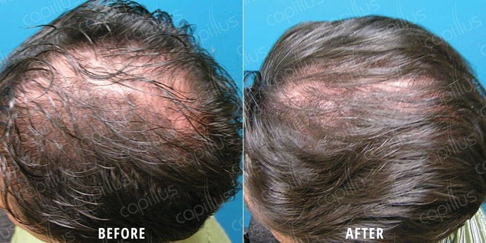 Before and after photo showing a man's scalp with thinning, balding hair before and more hair growth after Capillus Cap treatment in Houston, TX.