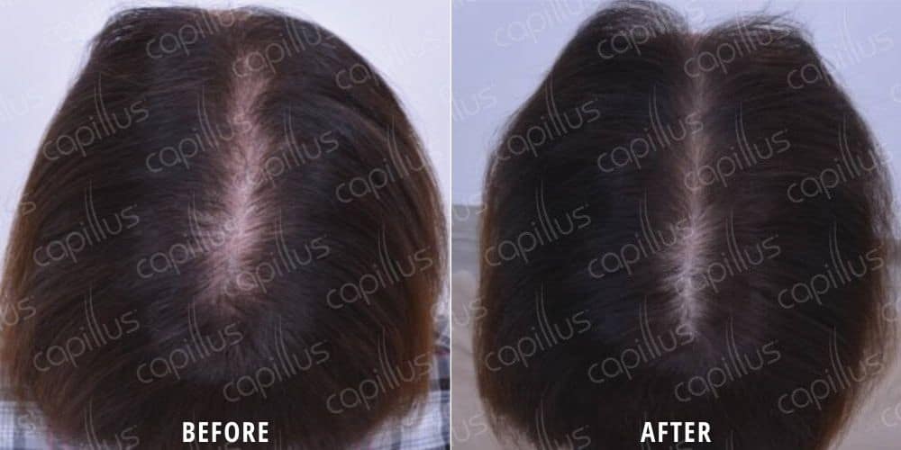 Before and after photo of patient's scalp with hair loss around the part in the middle of the scalp before and thicker, fuller hair after Capillus Cap treatment in Houston, Texas.