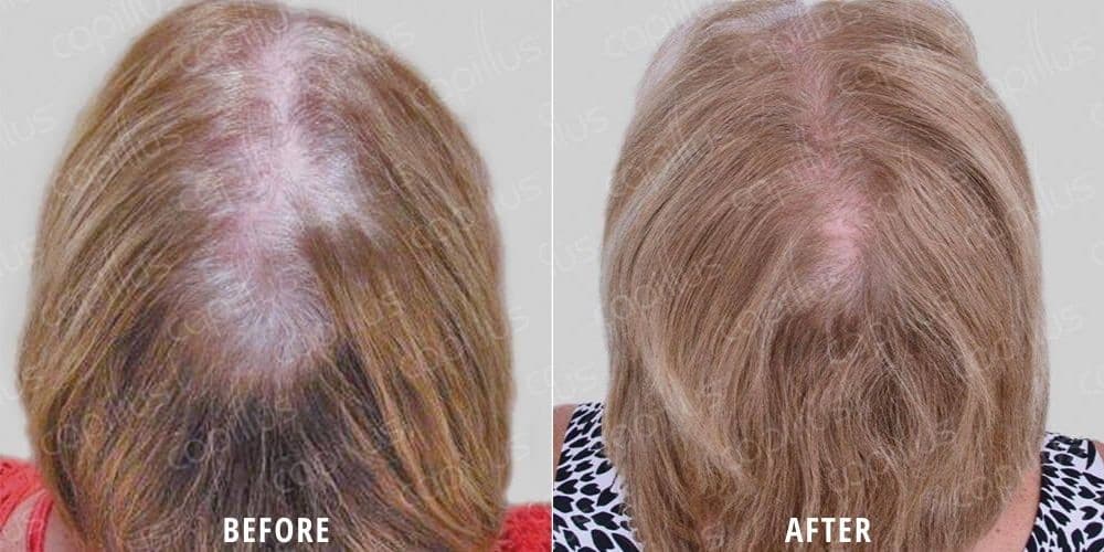 Before and after photo of a woman's scalp showing hair loss on the crown before and more hair growth after Capillus Cap treatment at ILEA Hair Restoration in Houston, Texas.