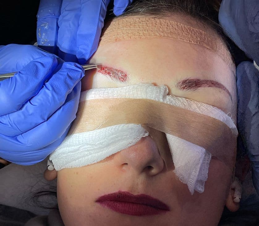 Photo of patient, Adriana, getting an eyebrow transplant at ILEA Hair Restoration.