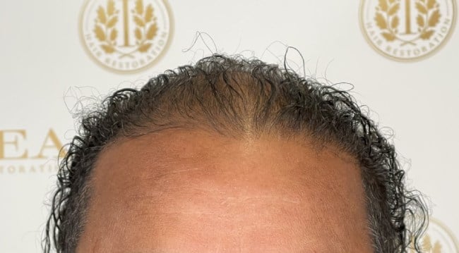 Man's scalp showing more hair growth four months after hair loss treatment at ILEA Hair Restoration in Houston, TX.