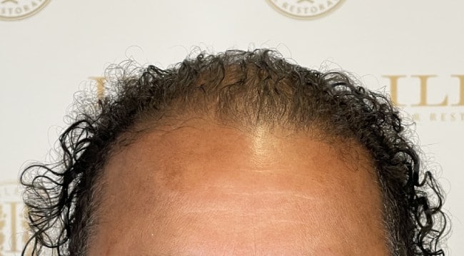 Man's scalp showing longer, thicker hair after hair loss treatment at ILEA Hair Restoration in Houston, Texas.