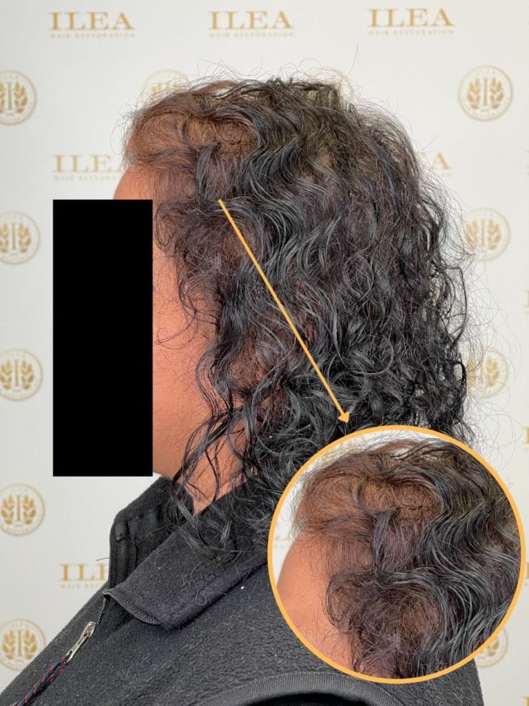 Photo of woman with thicker, fuller hair after LockRX Hair Loss Treatment at ILEA Hair Restoration in Houston, TX.