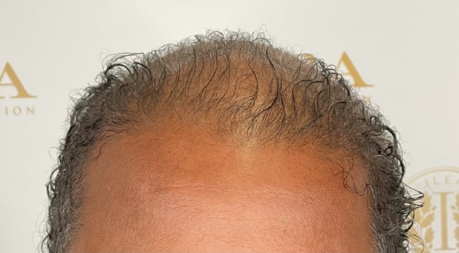 Man's scalp showing significant hair loss and thinning before hair loss treatment at ILEA Hair Restoration.