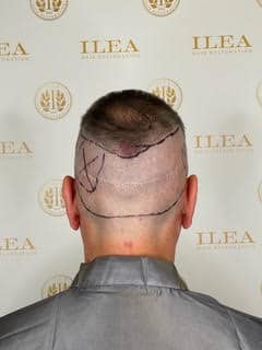 Photo of the back of Dr. Cesar's head before his FUE hair transplant surgery with markers showing where the transplant will be done.
