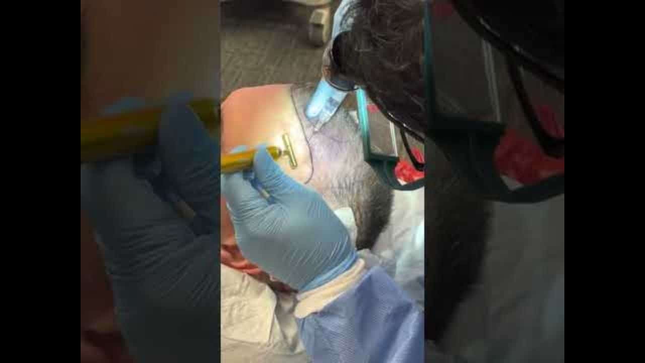 Dr. Cesar preparándose para la implantación