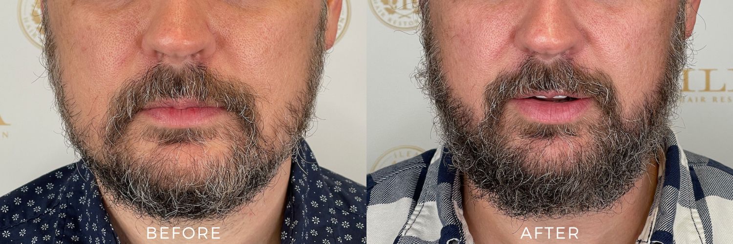 Before and after photos showing a man's beard with less definition before and a fuller, more defined beard after a beard transplant at ILEA Hair Restoration.