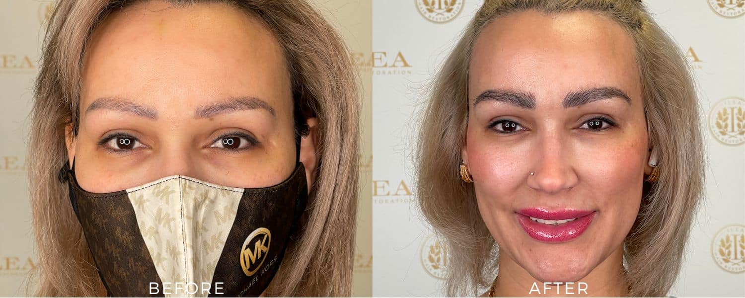 Before and after image of woman with thin, sparse eyebrows before and thicker, fuller eyebrows after an eyebrow transplant at ILEA Hair Restoration.