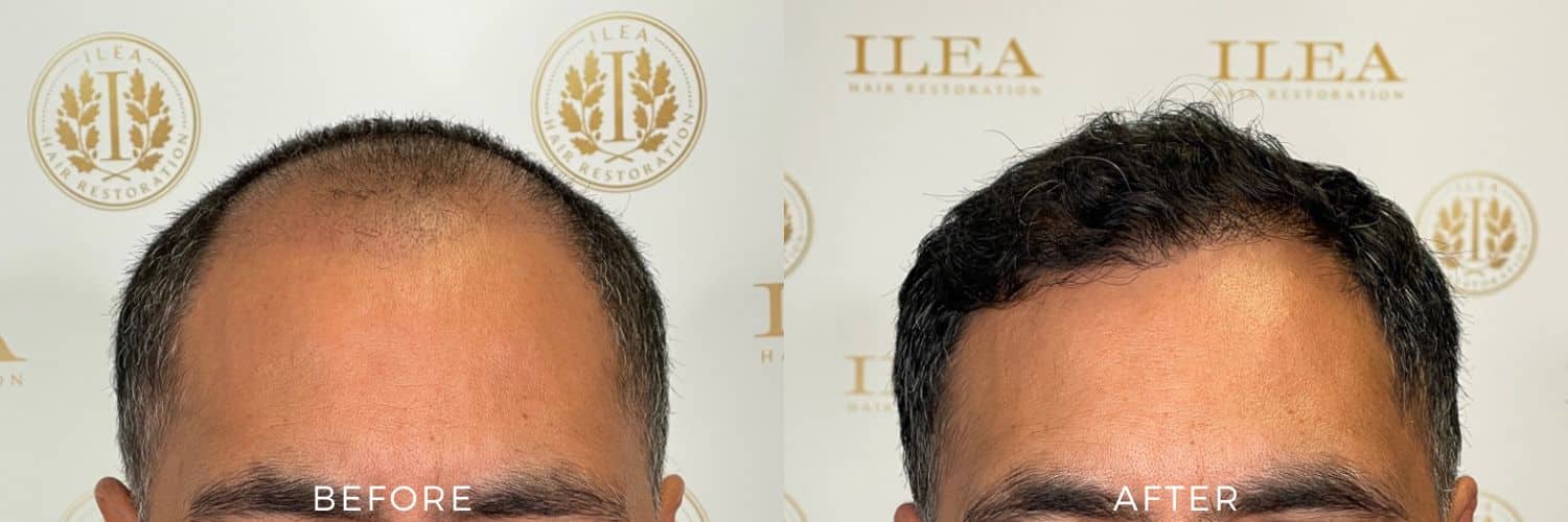 Before and After | Real Patients, Real Results in Houston, TX.