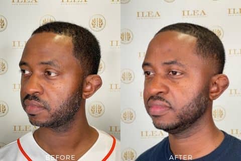 Before and after photo showing the profile of a man showing a receding hairline and thinning hair before and thicker hair with more defined hairline after an FUE hair transplant at ILEA Hair Restoration.