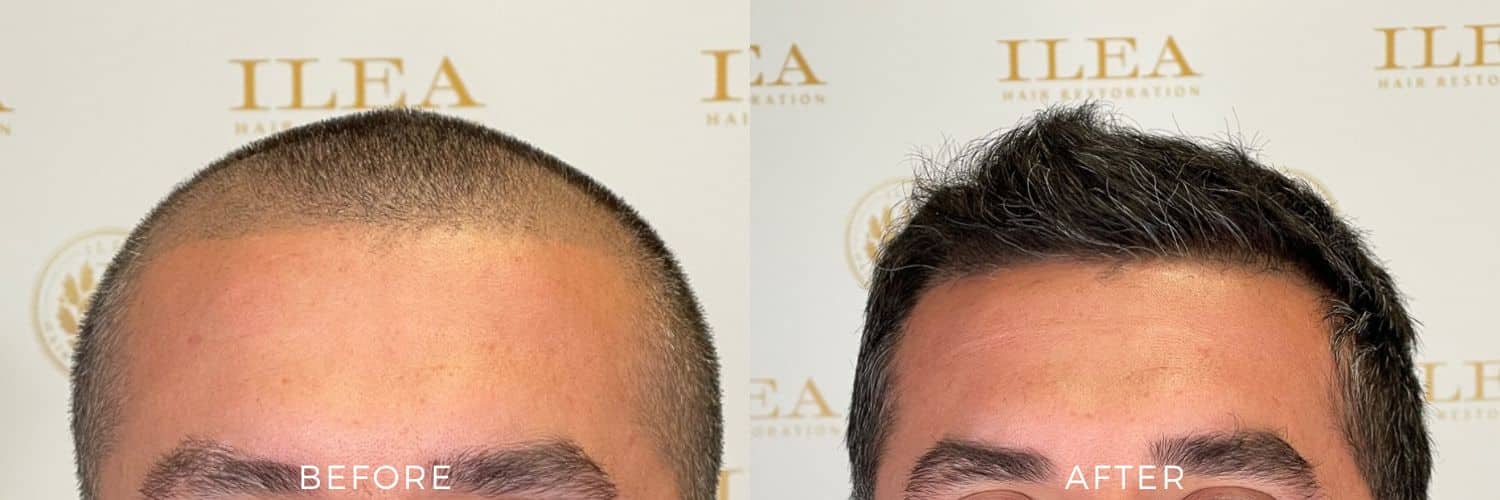 Before and after photo of a 36-year-old man showing patchy, thinning hair on his scalp before and a thicker, full head of hair after an FUE hair transplant in Houston, TX.