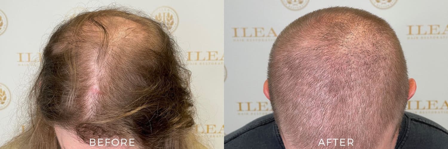 Before and after photo showing a 37-year-old man with hairloss on his crown before and fuller, thicker hair after an FUE hair transplant in Houston, TX.