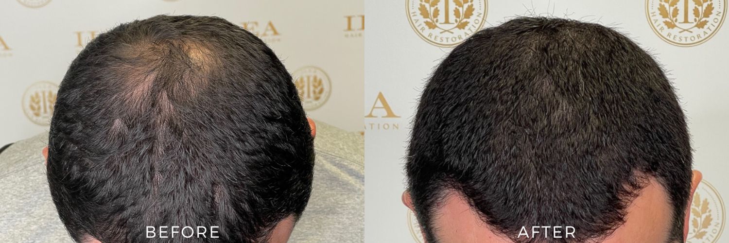 Before and after photo showing a 34-year-old man with hair loss on the crown and a receding hairline before and full, thicker hair after an FUE transplant at ILEA Hair Restoration in Houston, TX.