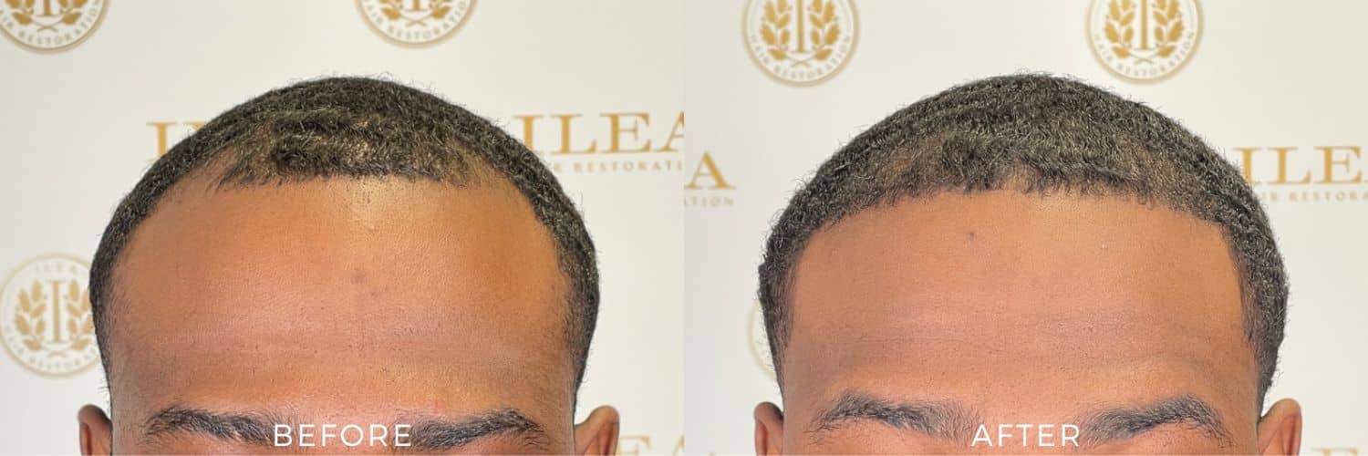 Before and after photos showing a 25-year-old man with a receding hairline before and a fuller, more defined hairline after an FUE hair transplant.