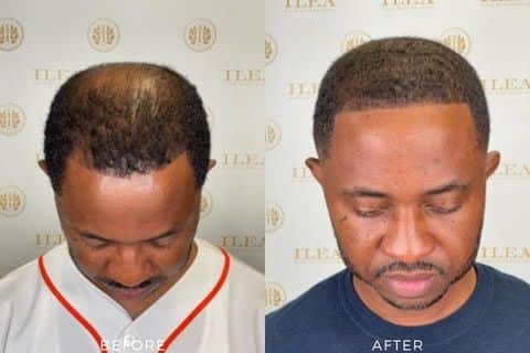 Before and after photo of a 41-year-old man showing the hair loss on the crown before and fuller, thicker hair after an FUE hair transplant at ILEA Hair Restoration in Houston, TX.