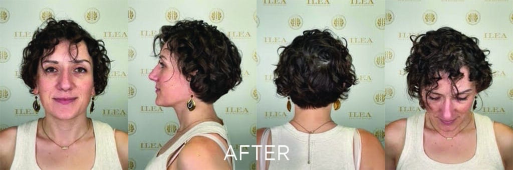 These before and after photos show a female patient 1 year after a hair transplant of 2,030 grafts. She has also been on oral minoxidil and LOCKrx hair supplements. The quality of her hair has dramatically improved, and the hair loss at the front of her scalp has been reversed.
