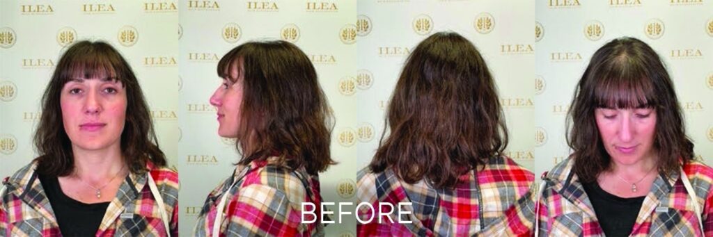 These before and after photos show a female patient 1 year after a hair transplant of 2,030 grafts. She has also been on oral minoxidil and LOCKrx hair supplements. The quality of her hair has dramatically improved, and the hair loss at the front of her scalp has been reversed.