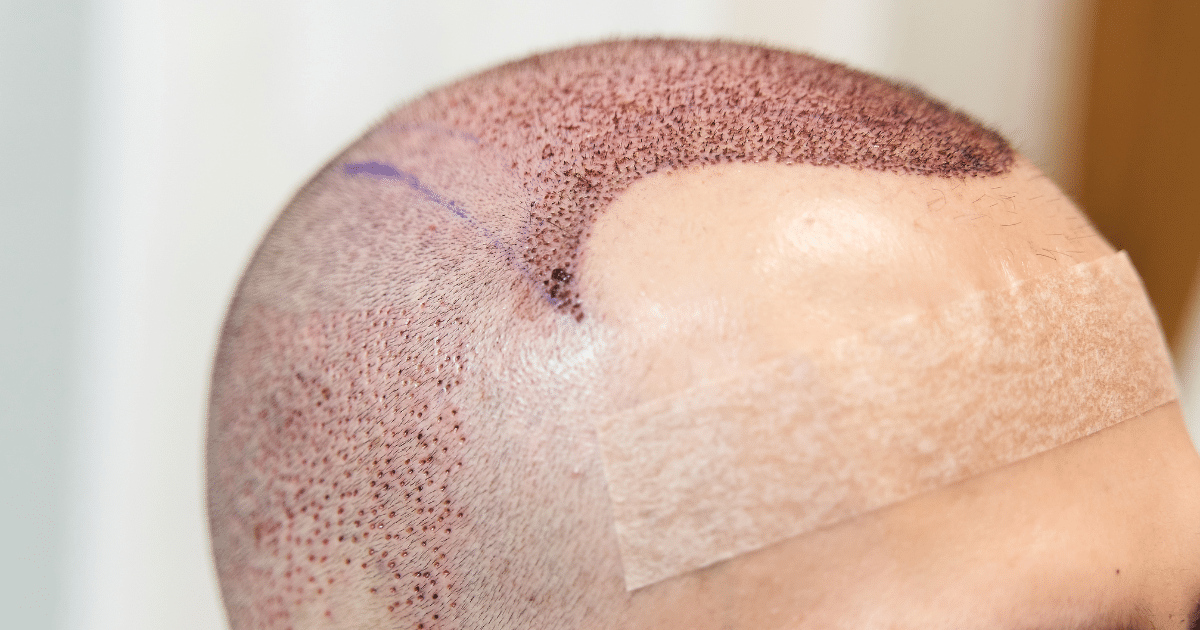 Técnica inadecuada de micropigmentación del cuero cabelludo